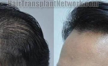 Hair transplantation surgery before and after pictures