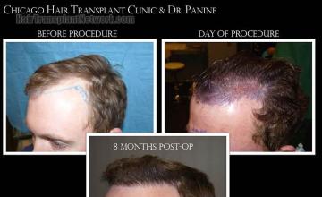 Hair transplantation surgery before and after pictures