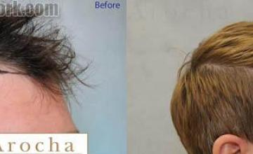 Hair restoration procedure before and after pictures