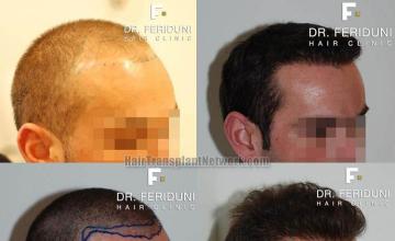 Hair transplantation surgery before and after images