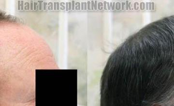 Hair transplantation surgery before and after images