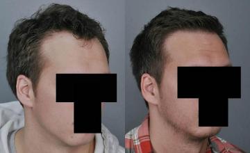 Hair transplantation surgery before and after images