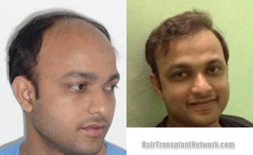 Hair transplantation surgery before and after photos