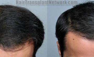 Top view before and after hair restoration results