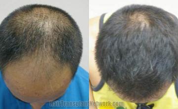 Top view before and after hair restoration results