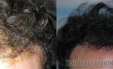 Hair transplantation surgery before and after images