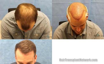 Hair transplantation surgery before and after images