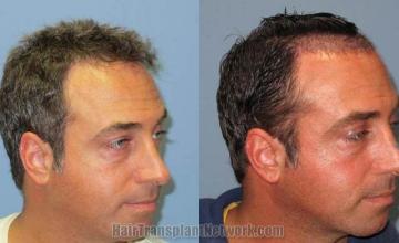 Hair transplantation surgery before and after pictures