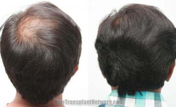 Back view before and after hair transplantation photos