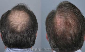 Hair restoration procedure before and after pictures