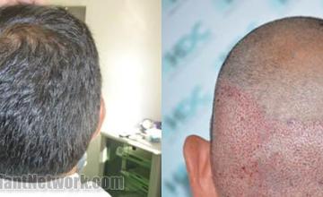 Hair restoration procedure before and after pictures