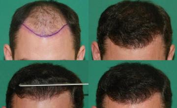 Hair restoration procedure before and after results