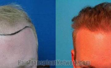 Before and after hair transplant procedure images