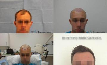 Before and after hair transplant procedure images