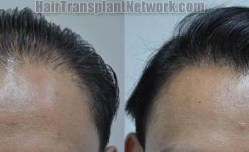 Hair restoration procedure before and after results