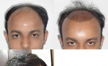 Hair restoration procedure before and after results