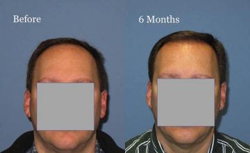 Hair restoration procedure before and after results