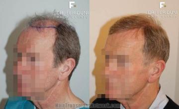 Hair transplantation surgery before and after images