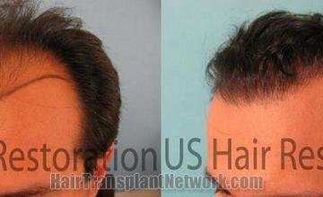 Left side views - hair replacement surgery photos