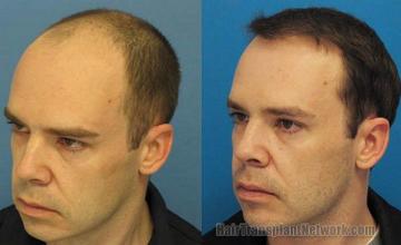 Hair restoration procedure results