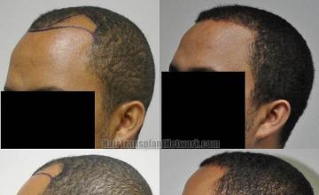 Hair transplantation surgery before and after images