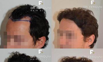 Hair transplantation surgery before and after photos