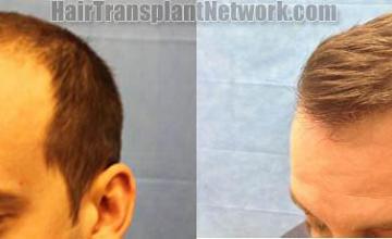 Hair restoration procedure before and after pictures