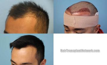 Hair transplantation surgery before and after photos