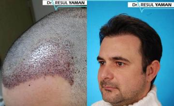 Hair transplantation surgery before and after photos