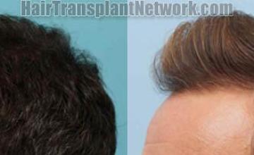 Hair transplantation surgery before and after pictures