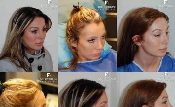 Right side photos of  female hair restoration results