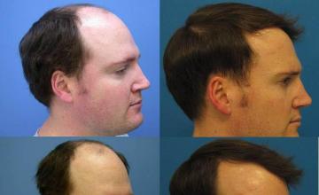 Right view - Before and after hair restoration