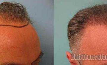 Hair transplantation surgery before and after photos