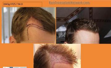 Hair restoration procedure before and after results