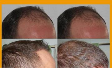 Hair transplantation surgery before and after images