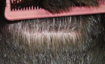 Hair restoration surgery before and after images