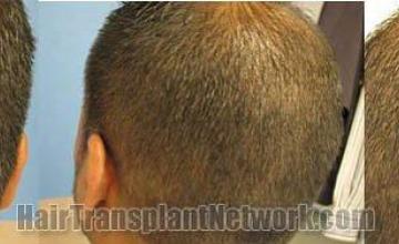 Donor area showing healed scar from hair transplant procedure