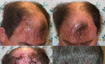 Hair restoration procedure before and after results