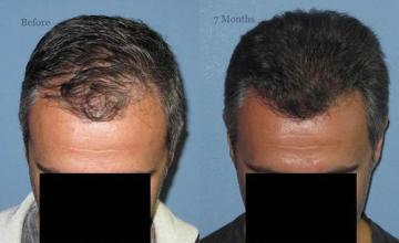 Hair transplantation surgery before and after photos