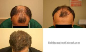 Top view before and after hair restoration results