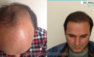 Hair restoration procedure before and after pictures