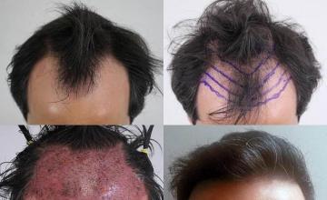 Top view before and after hair restoration results