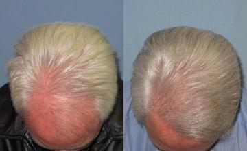 Hair transplantation surgery before and after photos