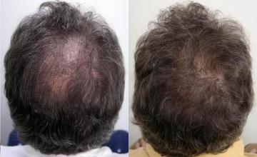 Hair restoration procedure before and after  photos