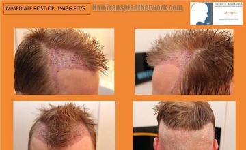 Hair restoration surgery before and after images