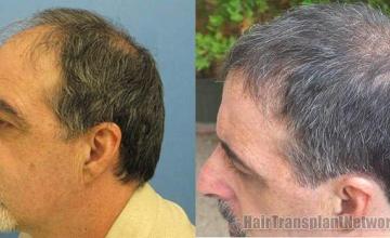 Hair transplant photos showing left side before and after