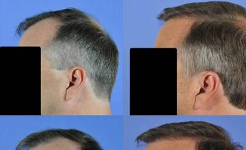 Left views before and after hair restoration procedure