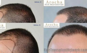 Left view before and after surgical hair restoration repair