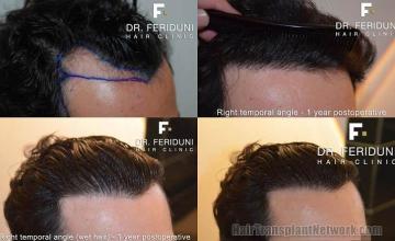 Hair restoration procedure before and after pictures