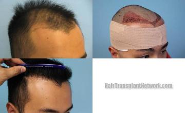 Hair restoration procedure before and after results